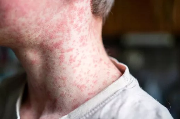 Measles Outbreak Sparks Emergency Warnings in 57 Nations